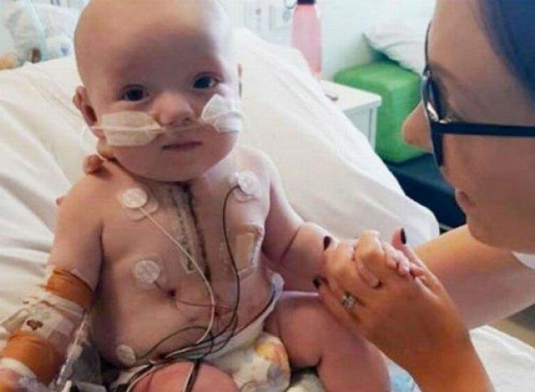 Μωρό «θαύμα» διαψεύδει τους γιατρούς και επιβιώνει με μισή καρδιά (photos)